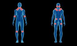 Fibromyalgia